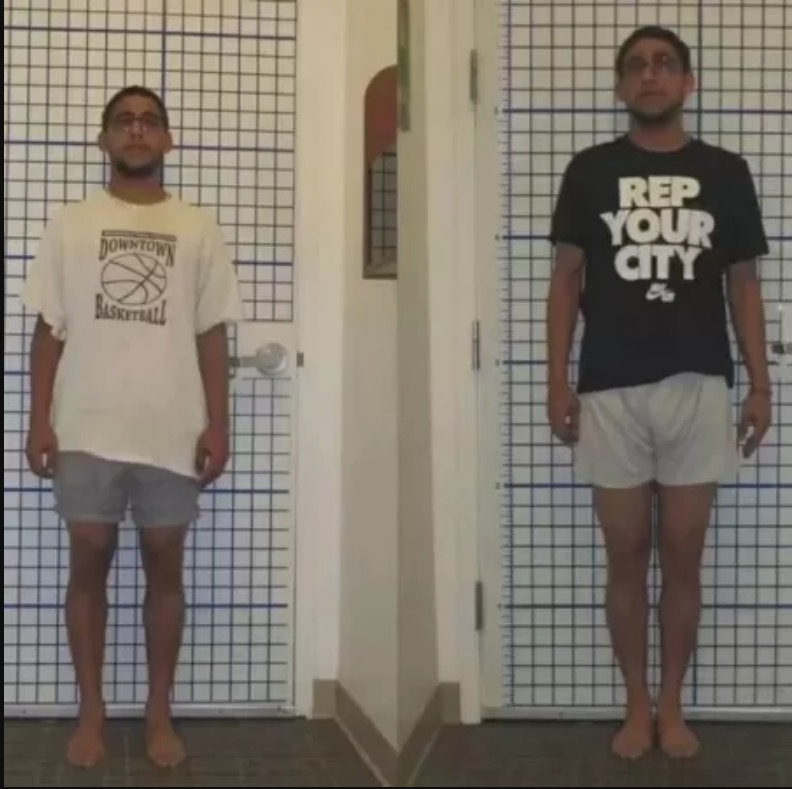 Cirurgia radical que quebra ossos para ficar mais alto está ficando popular entre homens