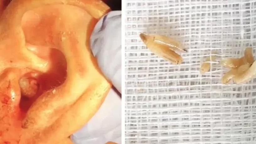 Médicos encontram infestação de larvas carnívoras no ouvido de homem