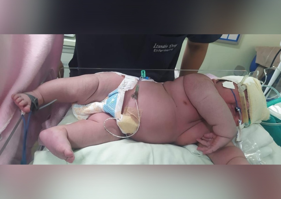 Bebê gigante nasce com 7,3 kg no Amazonas; hospital pede doação de fralda extra G