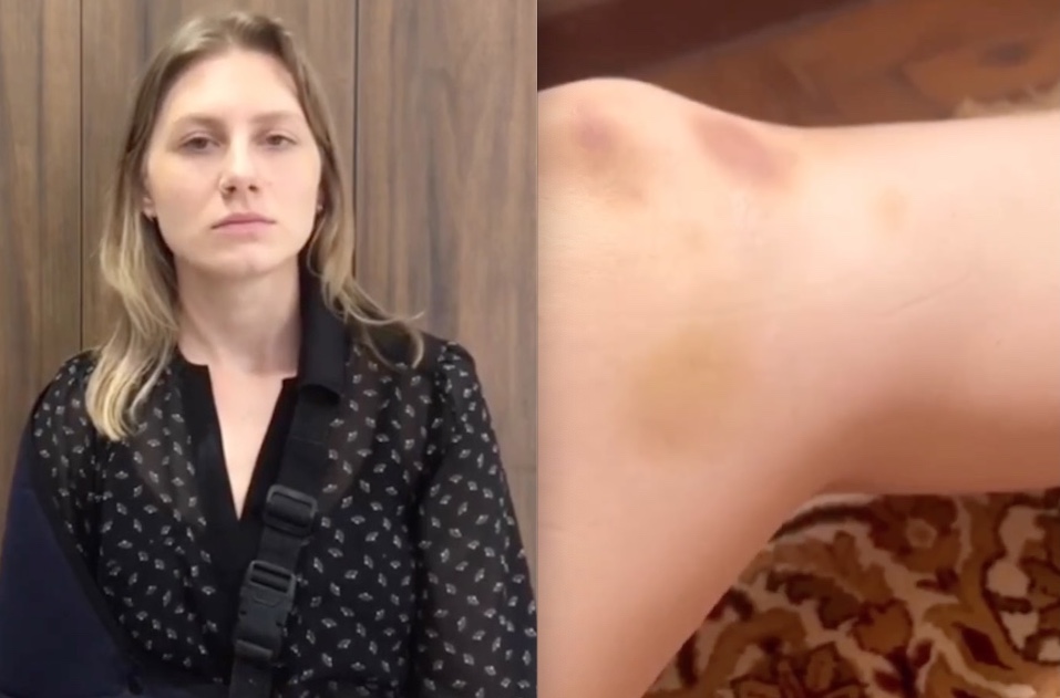 Comediante Lea Maria mostra hematomas e diz que ex tentou influenciar sua psicóloga