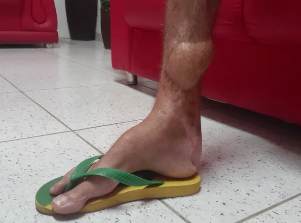 Homem é indenizado em R$ 15 mil por ficar 2 anos com caco de vidro enfiado na perna por erro médico