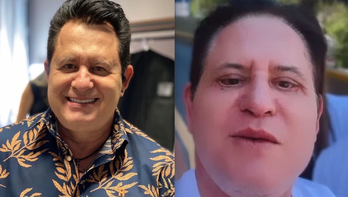 Marrone mostra resultado de cirurgia facial e divide opiniões 