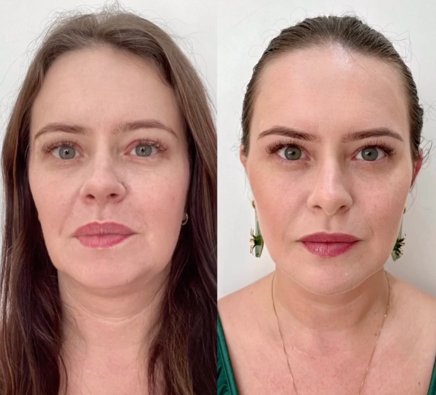 Mari Bridi faz harmonização facial e resultado surpreende; Veja antes e depois 