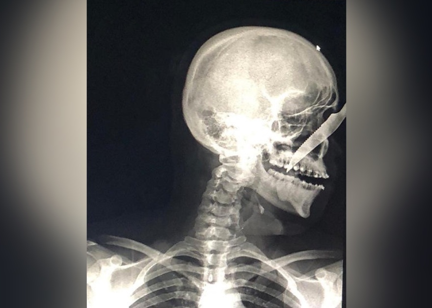 Bêbado, homem crava faca no rosto de jovem em rua no Amazonas