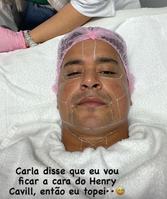 Xanddy mostra marcas para fazer procedimento no rosto: 'cara do Henry Cavill'