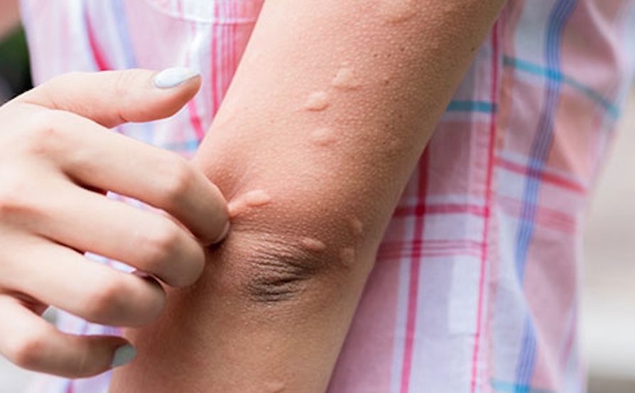 Conheça as alergias mais comuns e seus sintomas