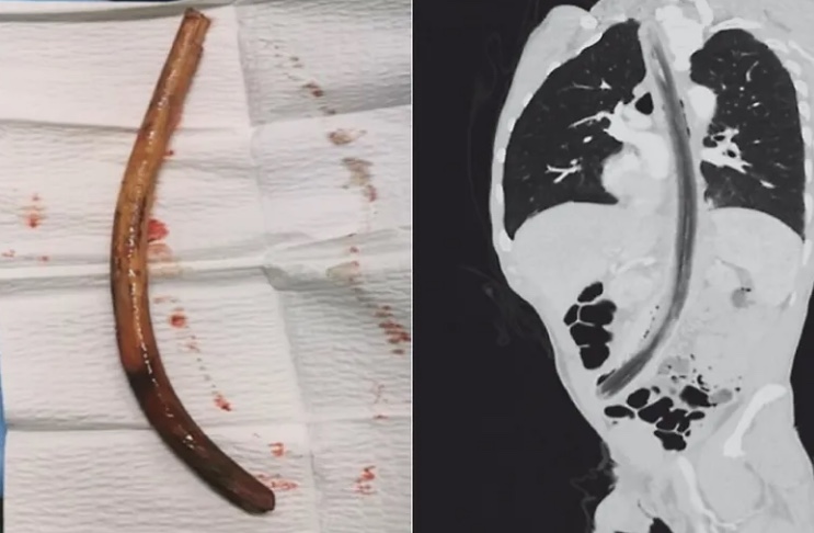 Homem engole pedaço de madeira de 30cm após ter sido ordenado por 'vozes'