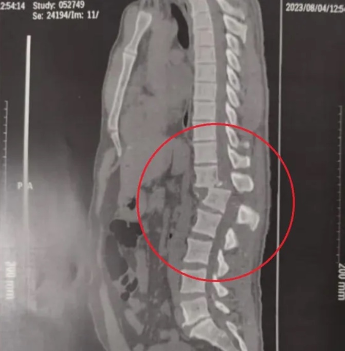 Veja raio x que mostra lesão grave na coluna de aluno atingido por aparelho de academia