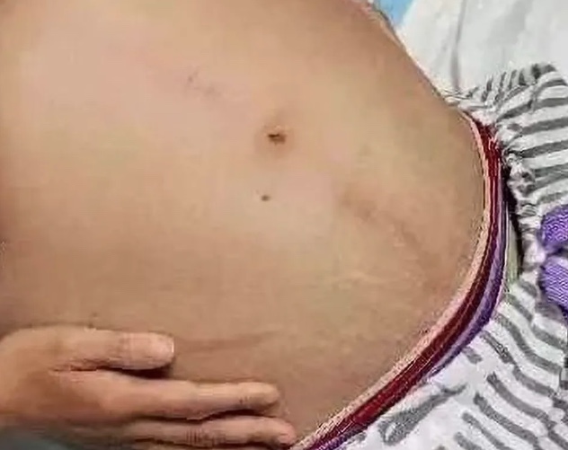 Mulher passa por cirurgia para retirar cocô gigante de 1 metro e 20kg