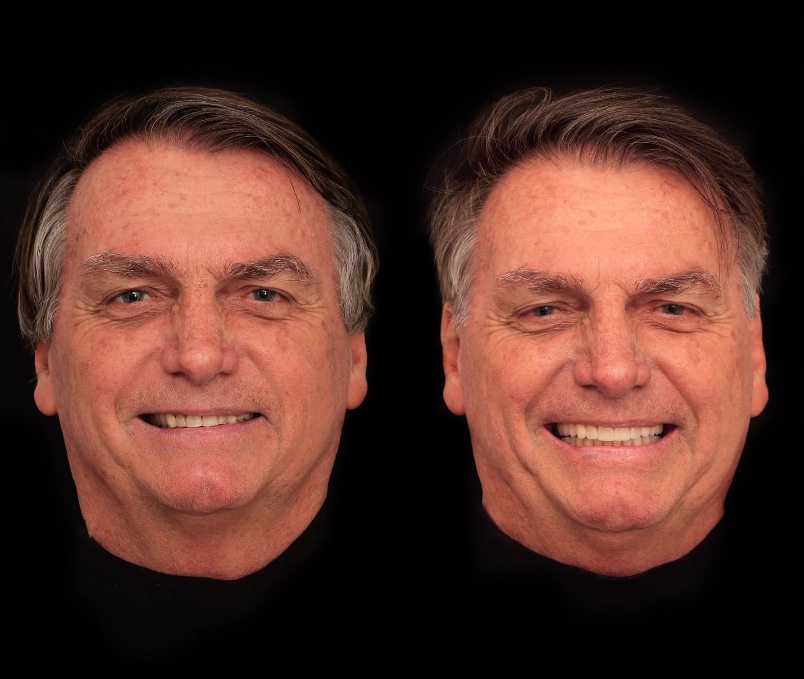 Jair Bolsonaro coloca lentes de contato nos dentes; veja o resultado