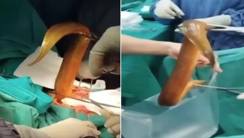 Homem passa por cirurgia após enfiar enguia de 60cm e limão no ânus para prazer