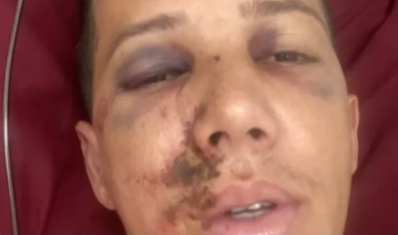 Árbitro sofre fraturas após ser agredido: “Poderia estar em cadeira de rodas”