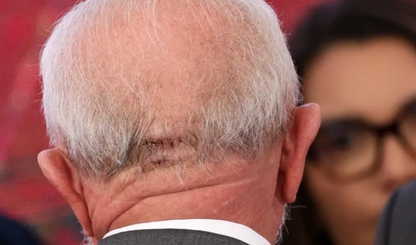 Lula volta a hospital para novos exames 12 dias após acidente doméstico