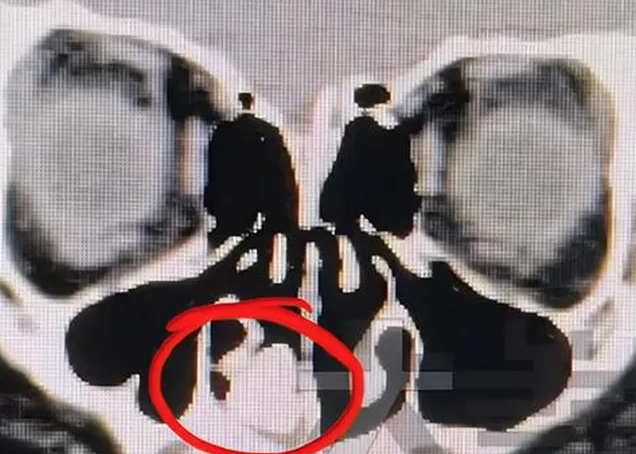 Menino descobre parafuso no nariz após 2 anos sentindo cheiro de ferrugem