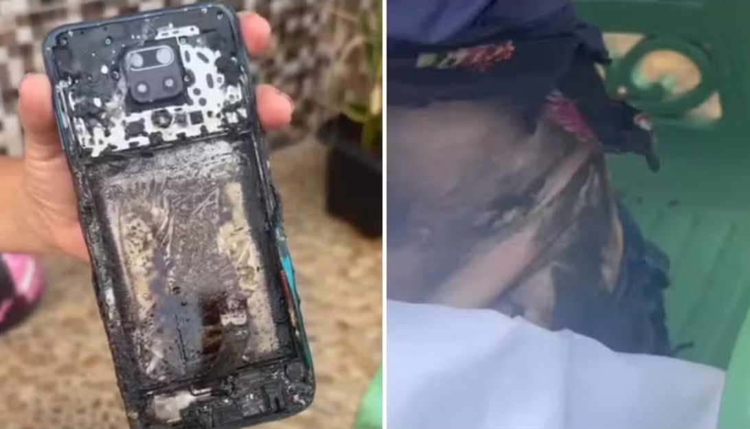 Técnica de enfermagem sofre queimaduras após celular pegar fogo em sua cintura