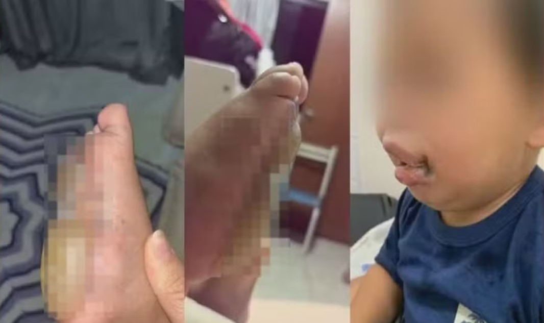 Creche é investigada após criança sofrer queimaduras de 2º grau nos pés; mães denunciam