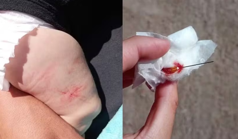Enfermeiro esquece injeção cravada na perna de bebê após aplicação de vacinas