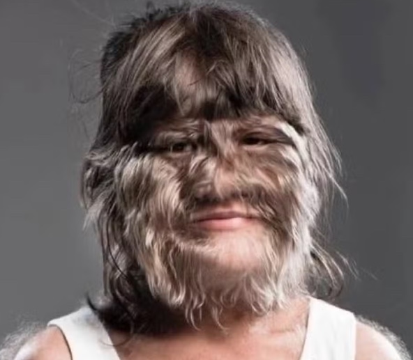 Ex-"garota mais peluda do mundo" surge transformada e casada