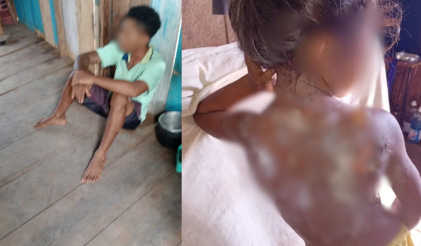 Padrasto é preso suspeito de jogar mingau quente em enteada em Autazes