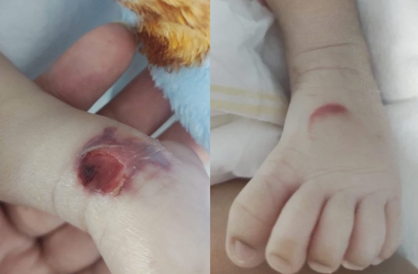 Família denuncia queimaduras em bebê prematuro na Maternidade Balbina Mestrinho