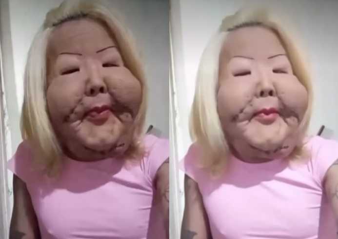 Juju do Pix relata complicação após cirurgia para retirar óleo mineral do rosto