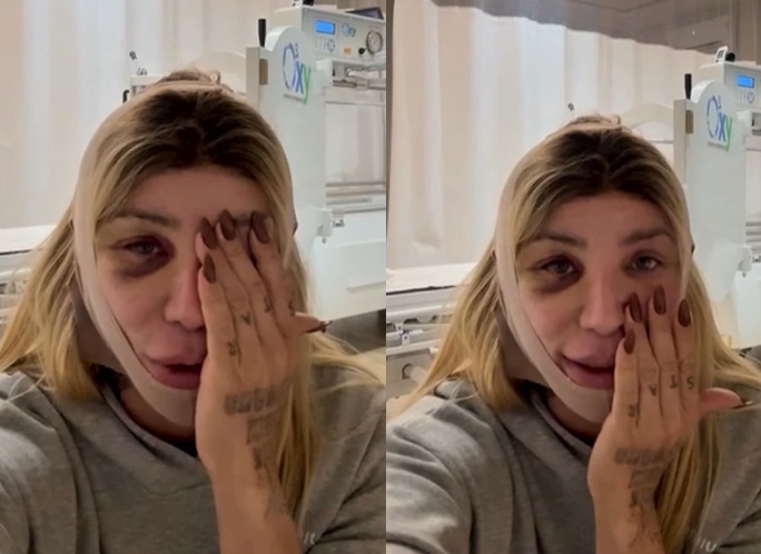 Maya Massafera passa por nova cirurgia no rosto e surge com olho roxo