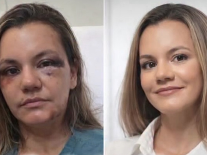 Mulher que levou 61 socos do ex mostra resultado da reconstrução facial; veja 