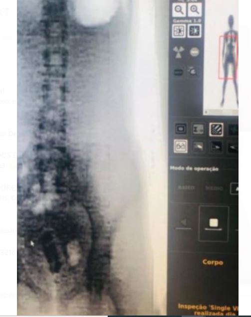 Mulher é flagrada em visita no Compaj com celular nas partes íntimas