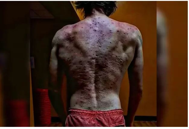 Homem fica com costas deformadas por espinhas após injetar anabolizantes