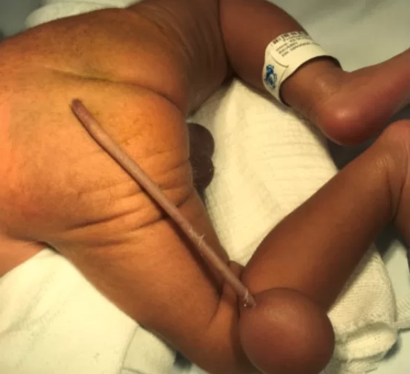 Em Fortaleza, bebê nasce com cauda e bola na ponta; veja fotos