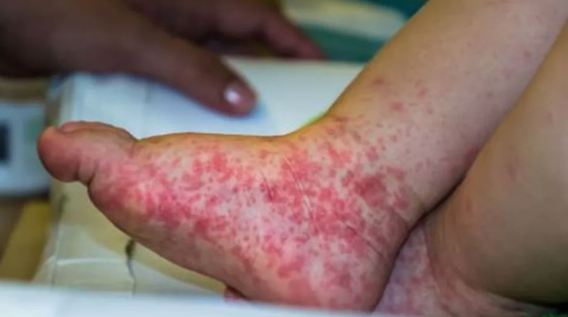 Surto de síndrome 'mão-pé-boca' em crianças acende alerta; conheça sintomas
