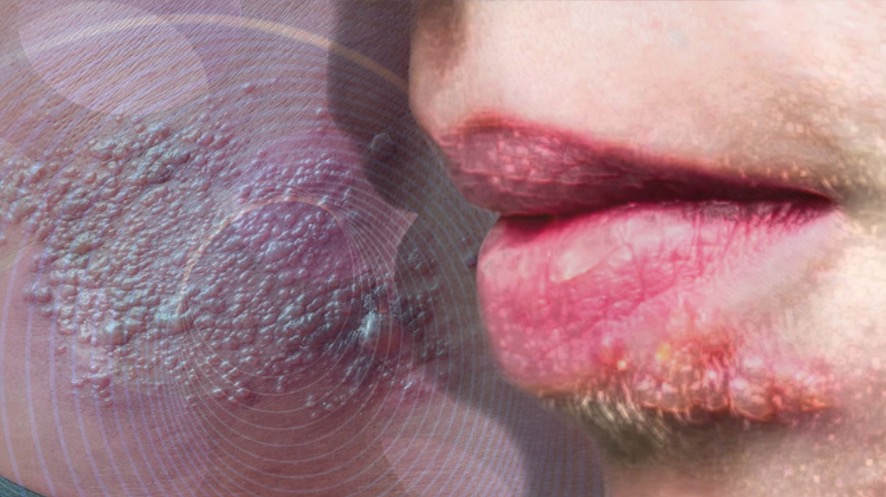 Entenda como acontece a transmissão do herpes labial