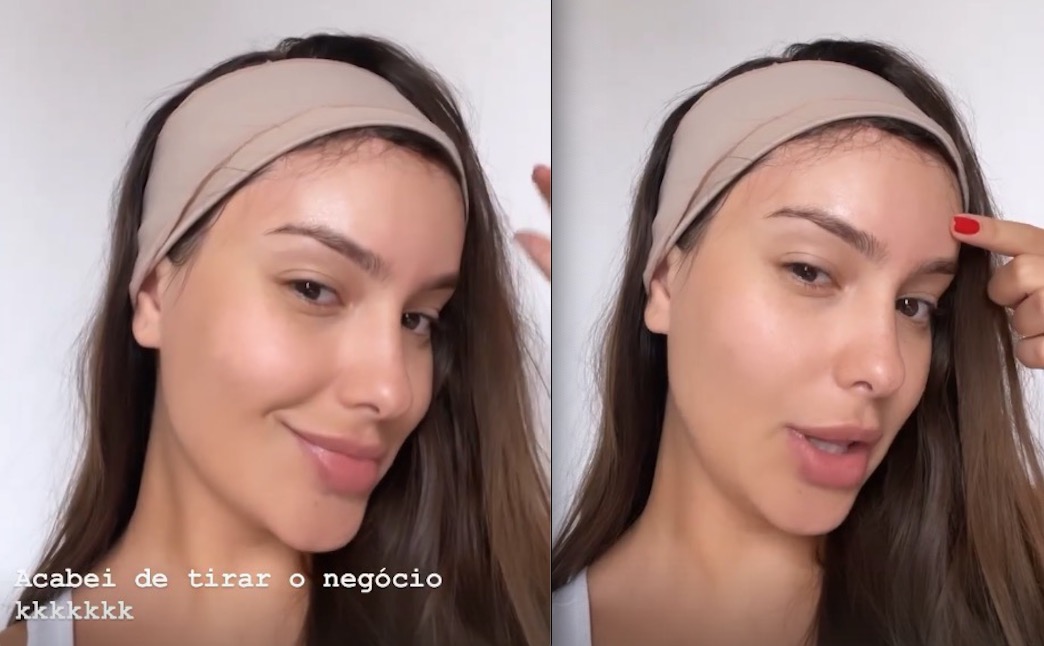 Ex-BBB Thaís Braz remove curativo e mostra testa pela primeira vez após cirurgia