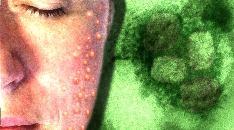 3° caso de varíola dos macacos é confirmado no Brasil