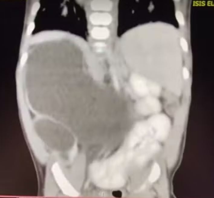 Bebê nasce com quatro rins no Brasil; condição é raríssima 