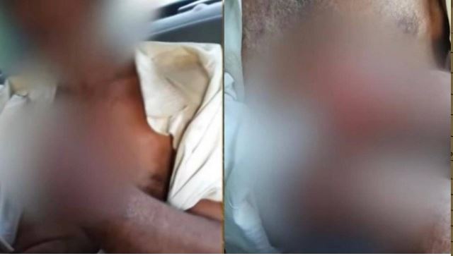 Patrão decepa mão de funcionário que roubou galinha por não receber salário