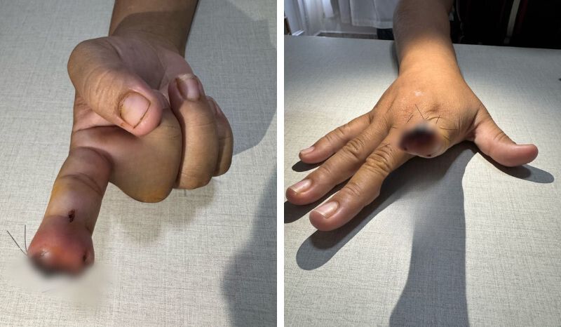 Homem arranca dedo da namorada com mordida em Manaus