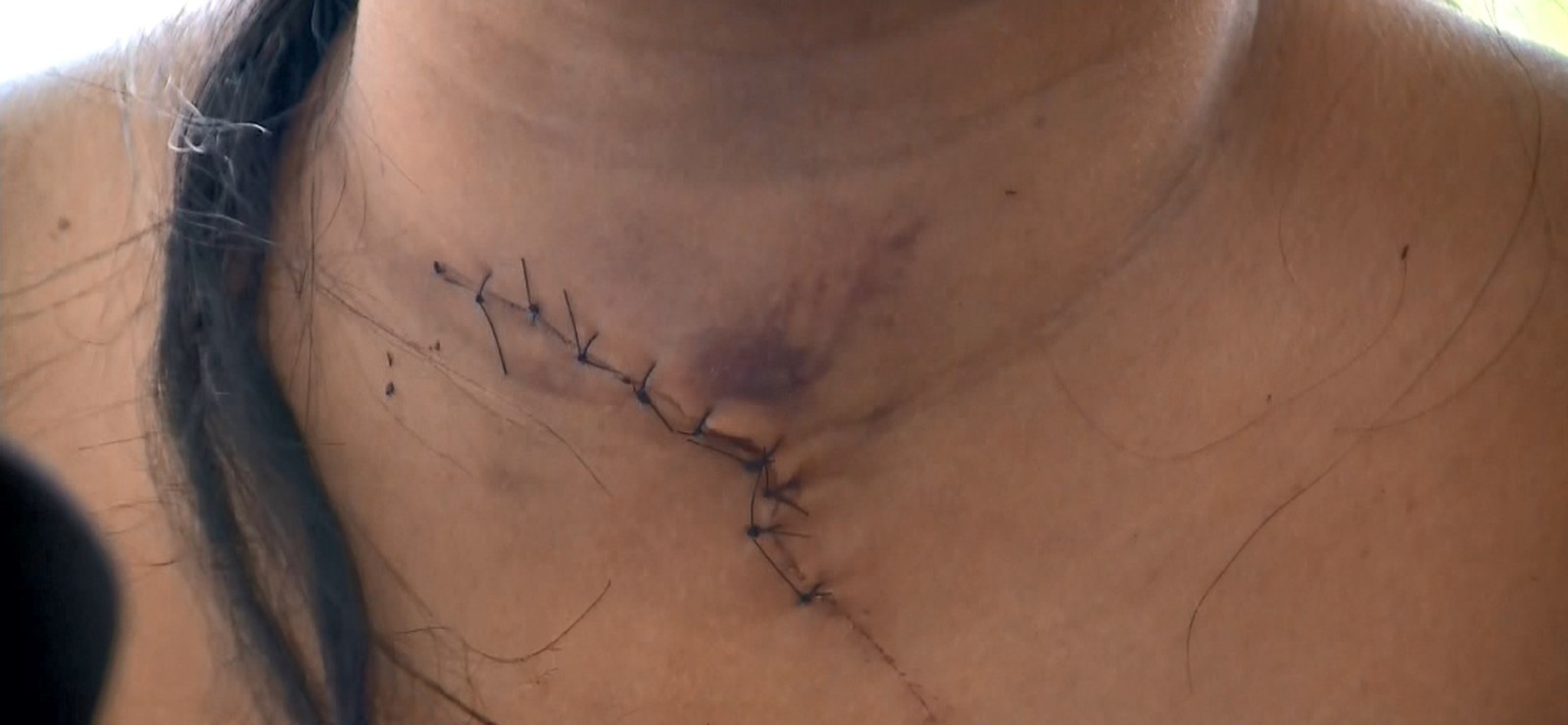 Idosa leva facada no pescoço e marido de 80 anos fica ferido em assalto dentro de casa