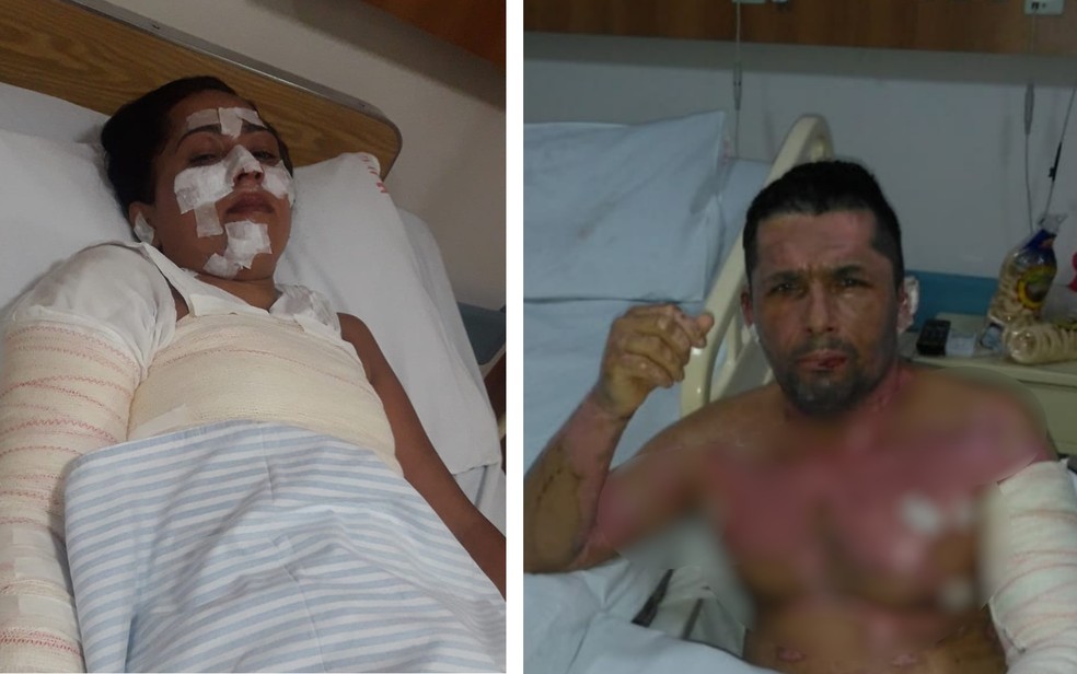 Sem dinheiro pro gás de cozinha, família se queima tentando fazer fogo