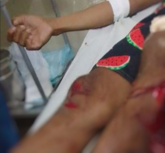 Perna de homem é dilacerada ao ficar presa em roda de moto em movimento no Amazonas