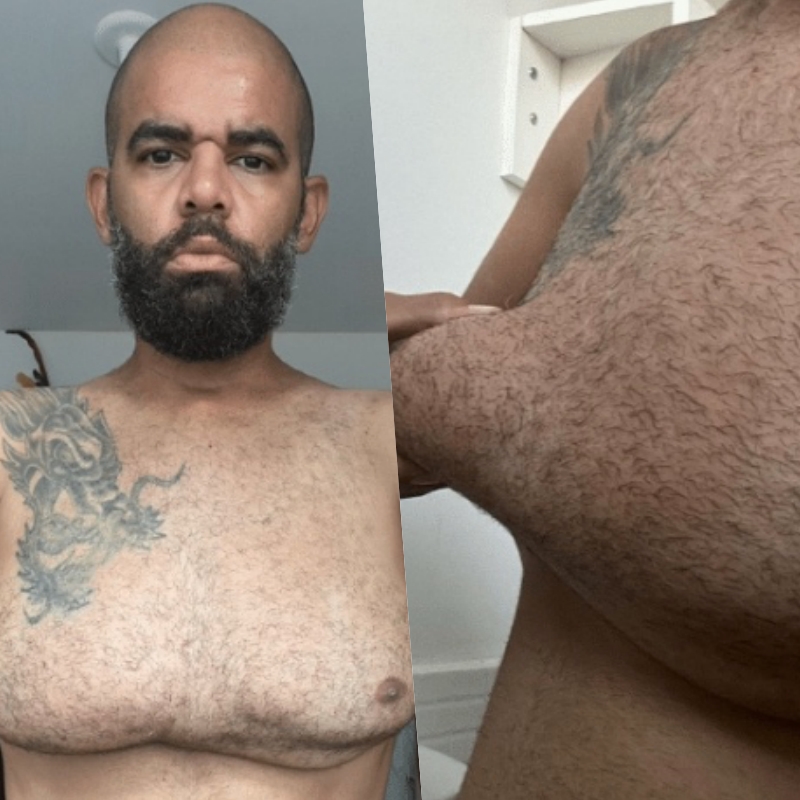 ‘Queria um corpo de academia rápido’, diz homem que ficou deformado após injetar gel em casa