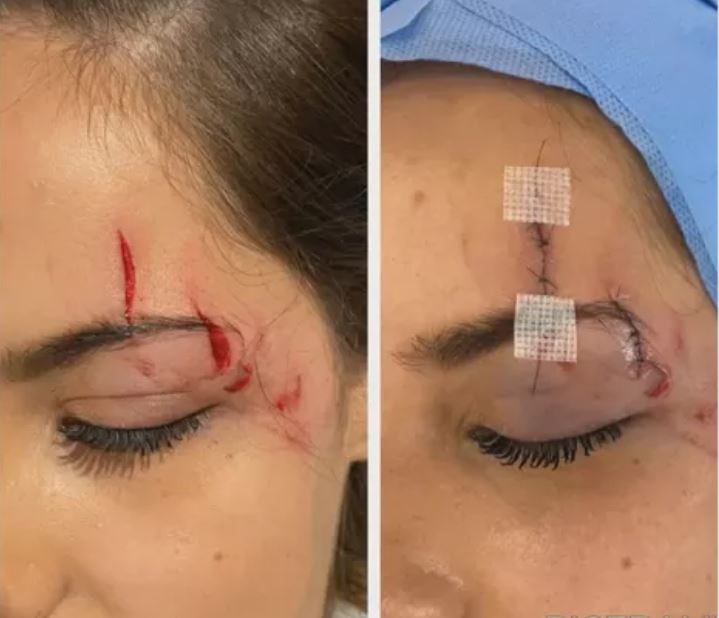 Veterinária passa por cirurgia após ser atingida por drone de banda durante show