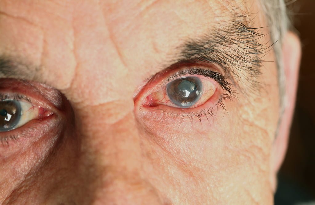 Dor nos olhos? Dificuldade para enxergar? Cuidado, pode ser glaucoma