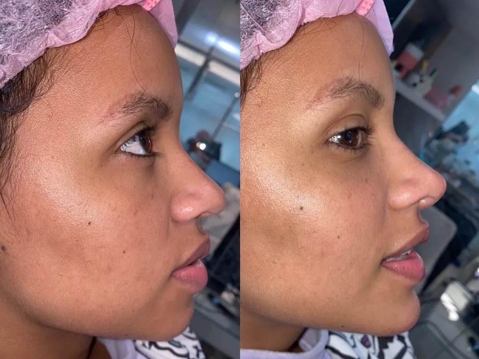 Gleici Damasceno faz harmonização facial; veja antes e depois