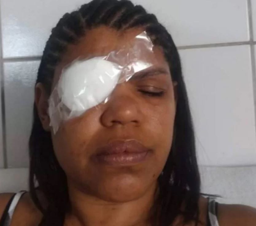 Pomadas para trançar cabelo deixam pessoas cegas e fazem Anvisa emitir alerta 