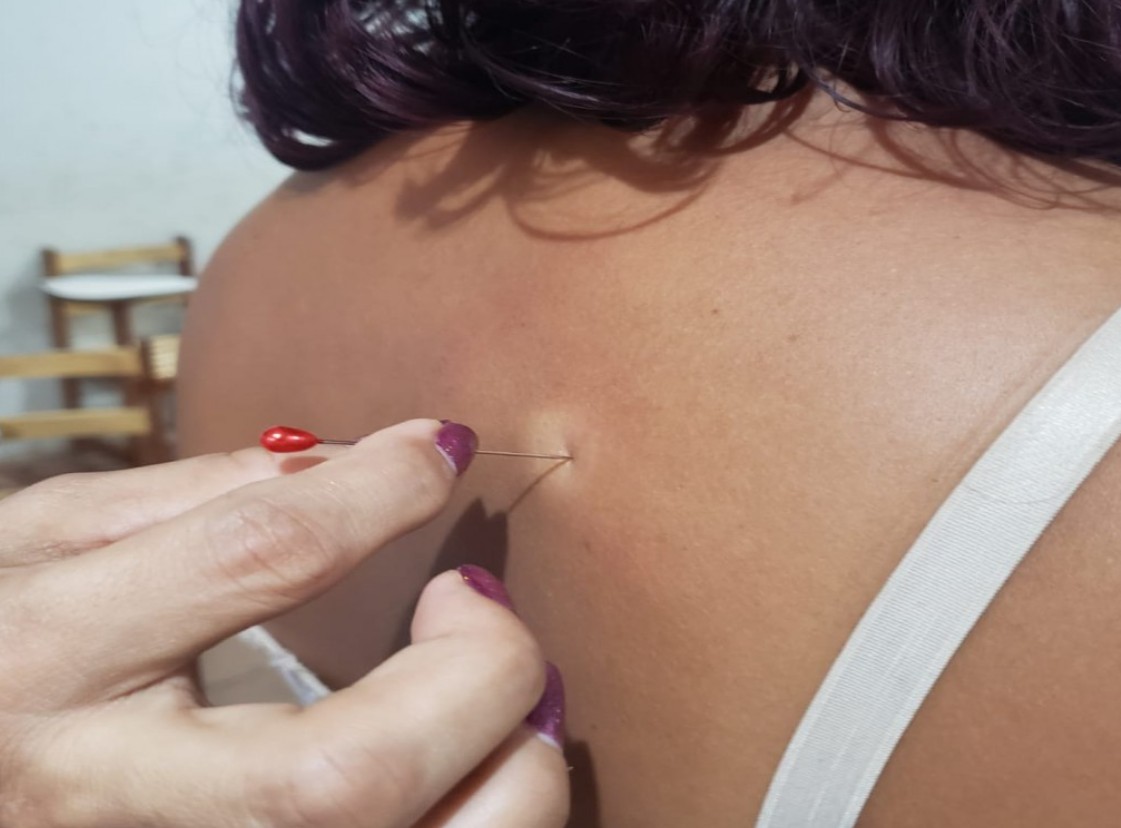 Saiba onde conseguir atendimento dermatológico gratuito na segunda-feira em Manaus