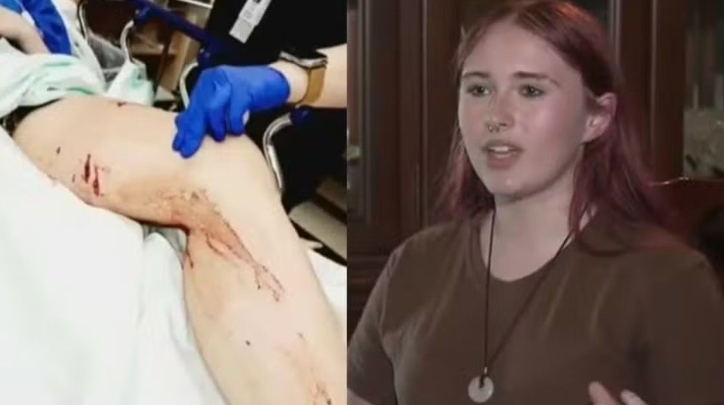 Adolescente sobrevive a ataque de jacaré durante banho de riacho