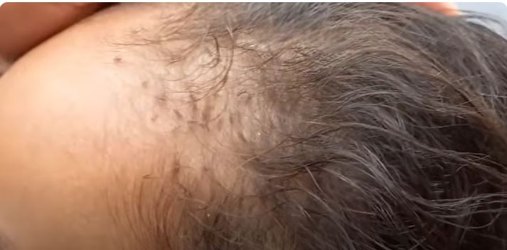 Salão de beleza é condenado a pagar R$ 3 mil por infestar cliente com piolho