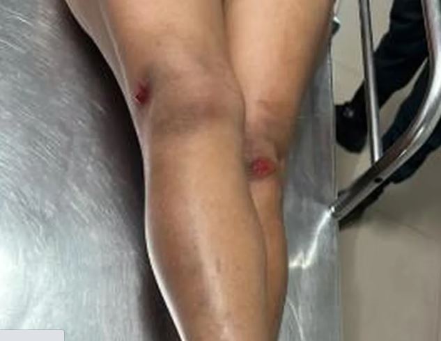 Garota de programa é agredida a tijoladas ao negar fazer programa por R$ 10