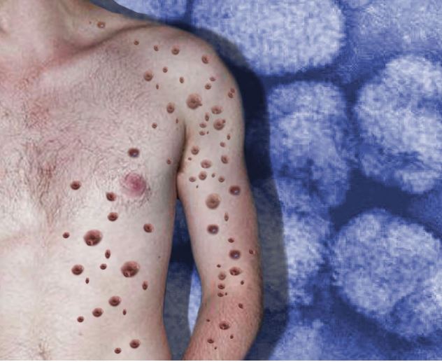 Saiba o estado de saúde de jovem suspeito de contrair varíola dos macacos no Amazonas